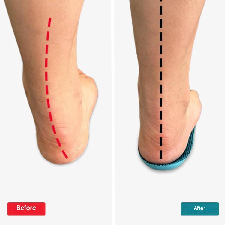 Orthopedische Inlegzolen – StepRelief