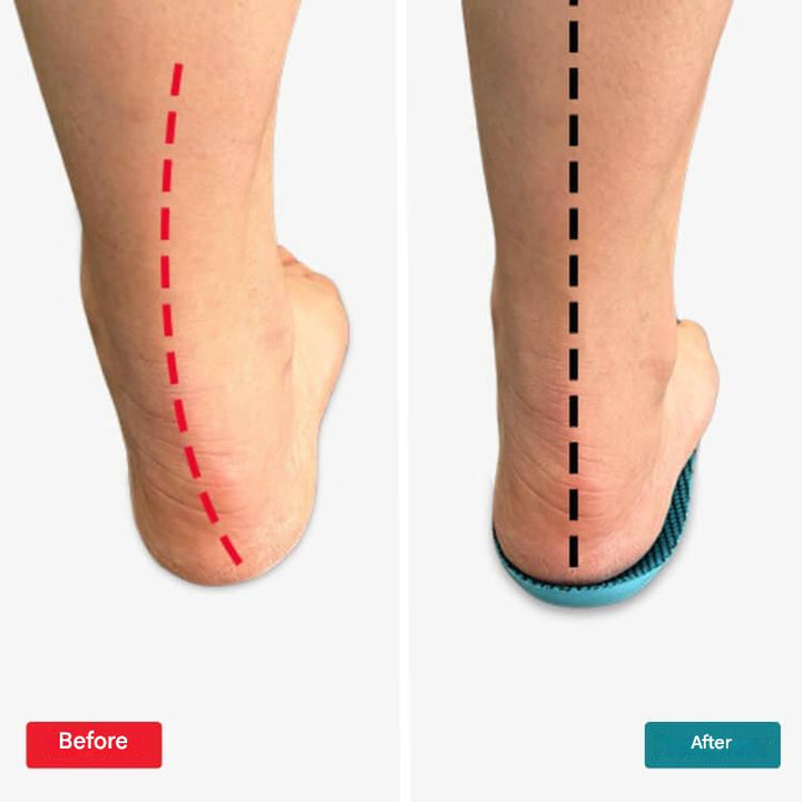 Orthopedische Inlegzolen – StepRelief